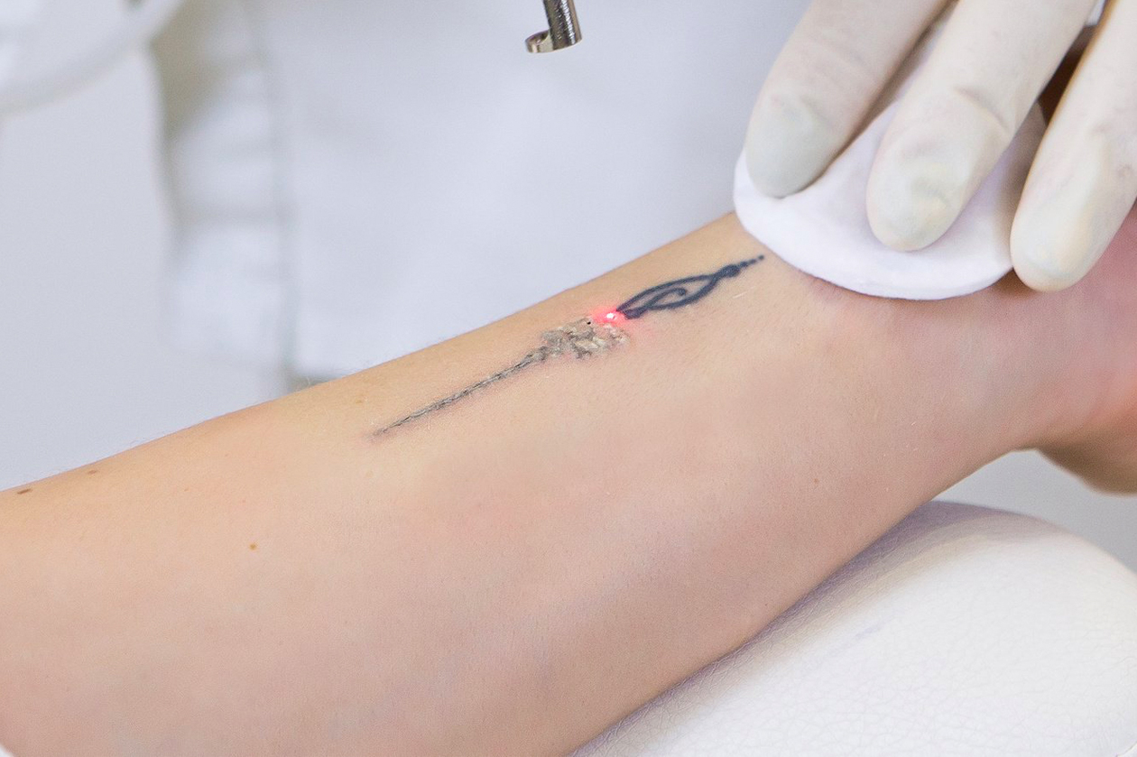 Tattoo Removal