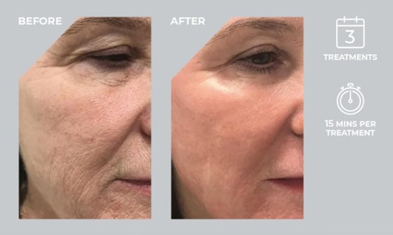 Co2 Laser Clinic | Skin Secrets | Pudsey, Leeds