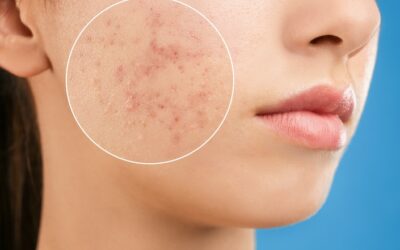 How to reduce acne scarring